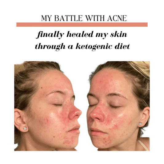 How I Got Rid of My Acne Using the Keto Diet and Eliminating Sugar - My Adventure to Fit